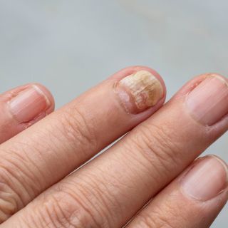 Skutecznie usuwa grzybicę u źródła